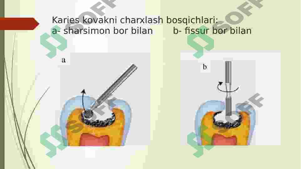 TISH QATTIQ TO`QIMA KASALLIKLARIDA NUQSONNING JOYLASHISH VA CHUQURLIGIGA QARAB KOMPOZIT PLOMBA ASHYOSINI TANLASH MEZONLARI 3
