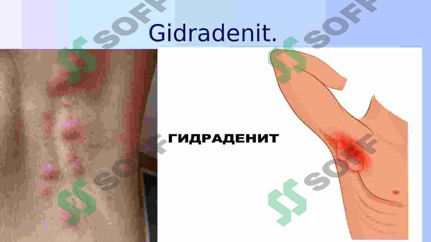 Gidradenit, mastit, paroproktit, erizepiloid etiologiyasi va patogenezi. 4