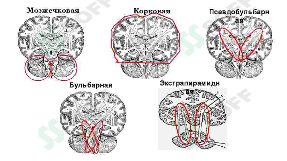 DIZARTRIYA 4