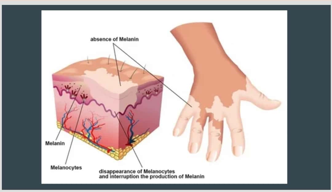 Vitiligo 1