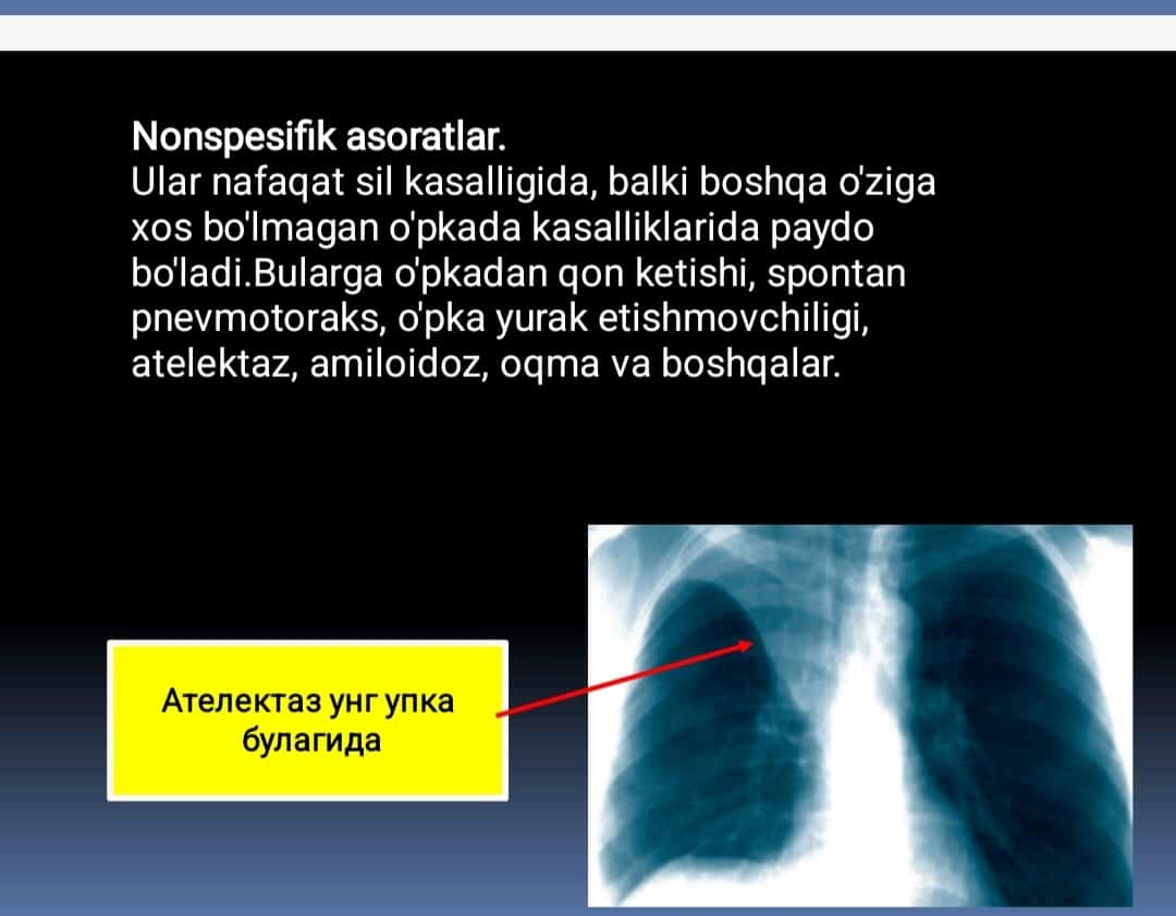 Oʻpka tuberkulyozi asoratlari. Tuberkulyoz bilan kasallangan bemorlarda nafas yetishmovchiligi 1