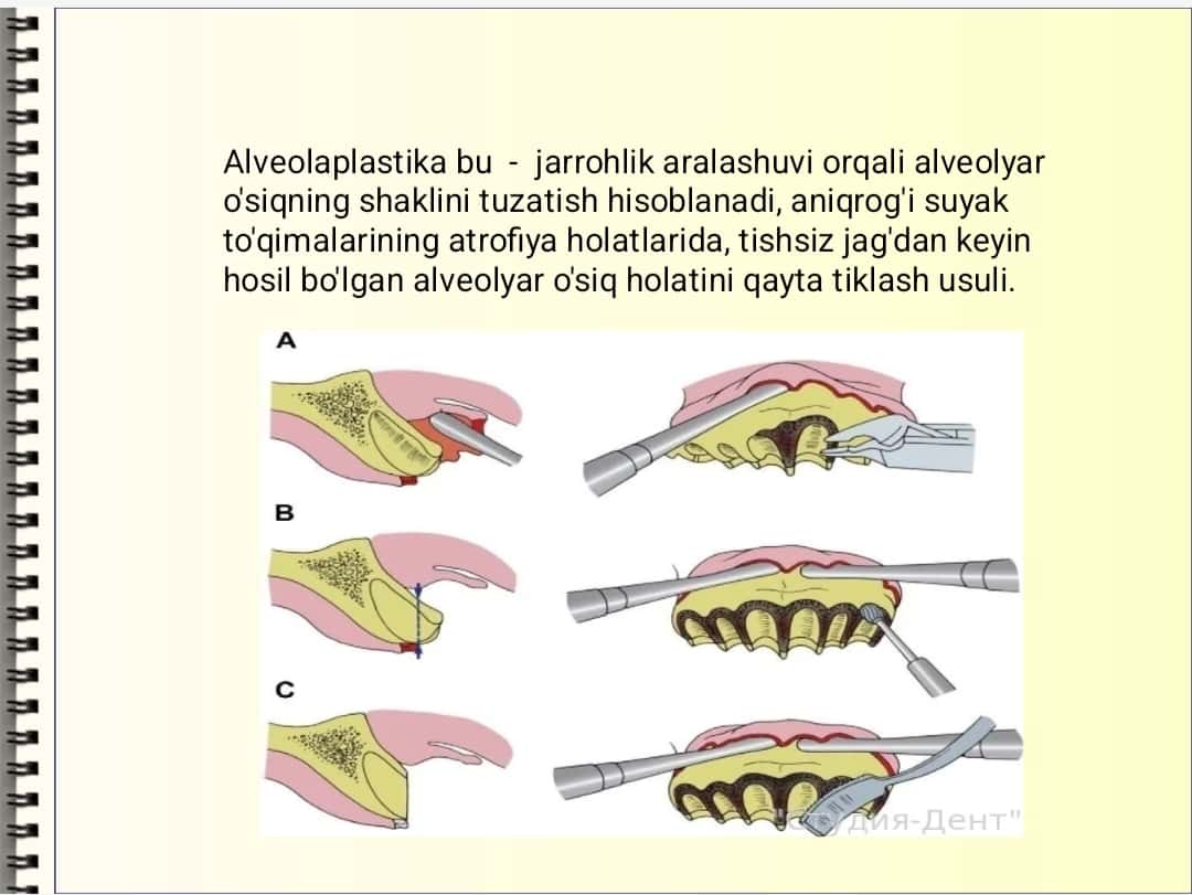 Alveolaplastika.Ko'rsatma va qarshi ko'rsatma 1