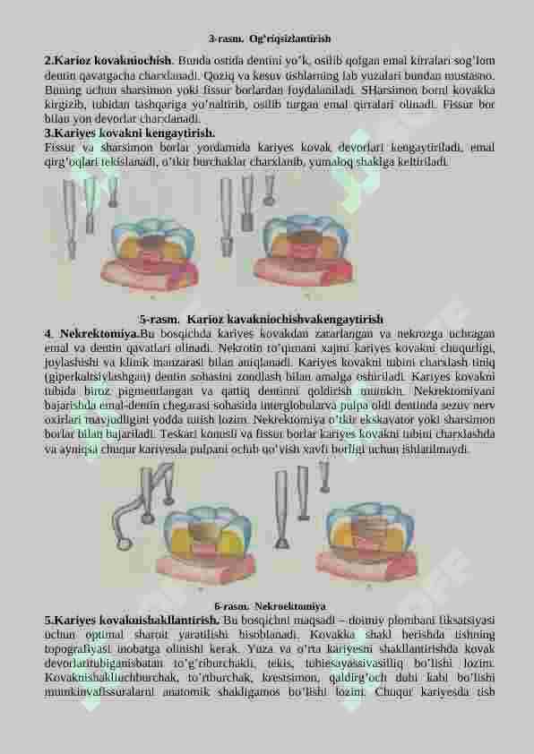 Tish qattiq to‟qimalarini charxlash bosqichlari va tamoyillari. Fantomlarda I sinf karioz bo‟shliqlarini charxlash va plombalash 3