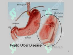 gastric and duodenal ppt 3