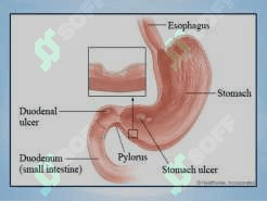 gastric and duodenal ppt 5