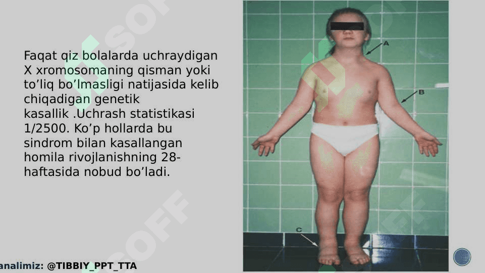 Shevshevskiy terner sindromi ppt 2