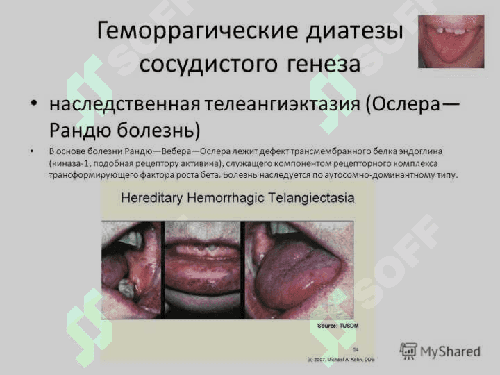 Gemorragik deatez (rus) ppt 4