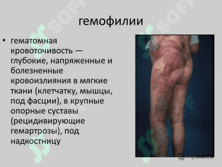 Gemorragik deatez (rus) ppt 7