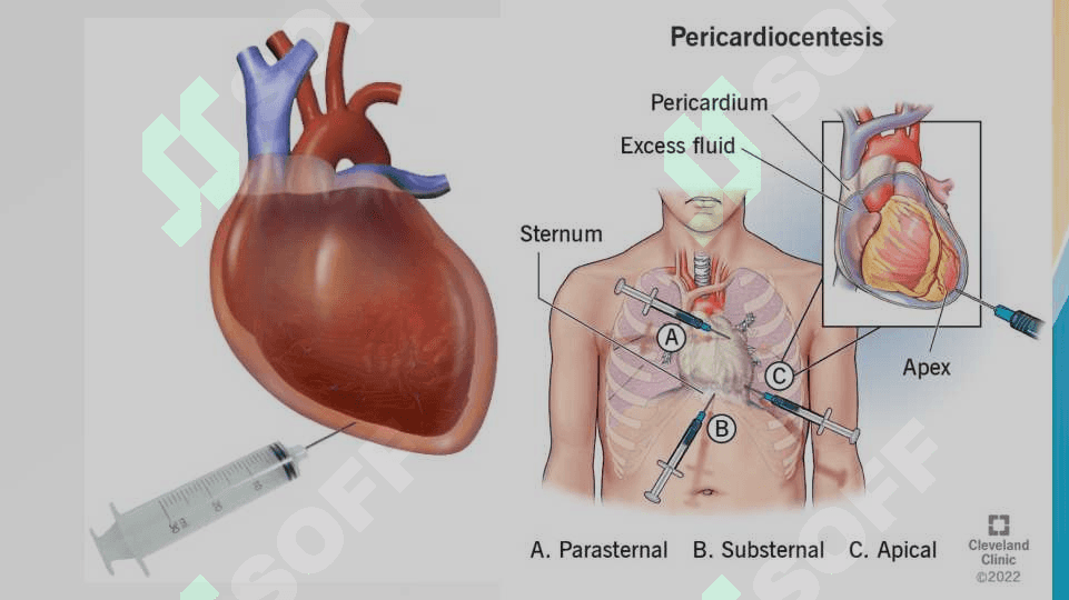 Perikarditda operatsiyalar. yurakn operatsiyalari 4