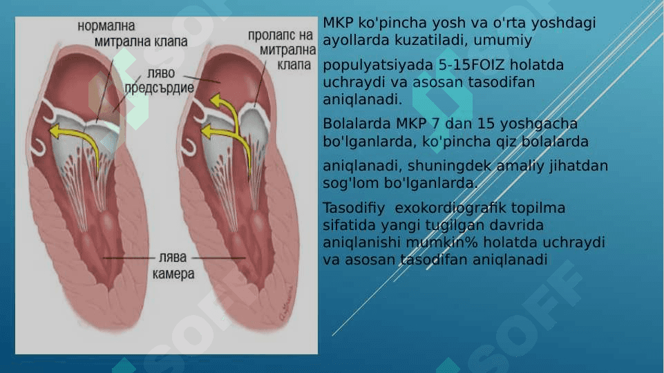 MITRAL KLAPAN PROLAPSI 4