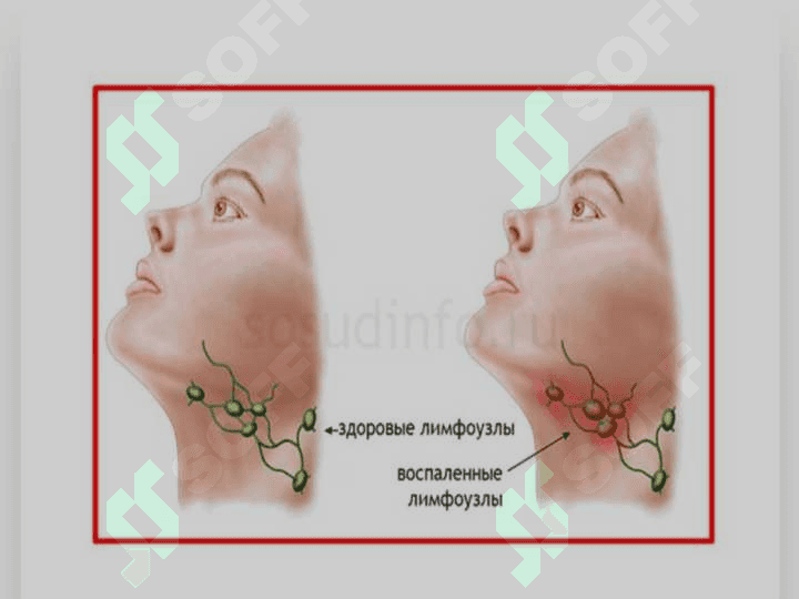 Limfaadenopatiya 4