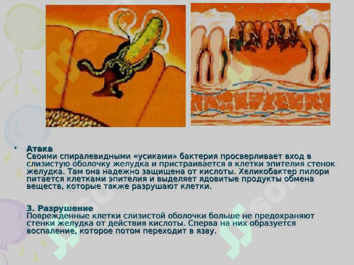 Гастритов и язвенная болезнь 6