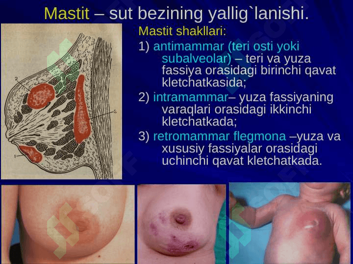 Ko`krakning Klinik anatomiyasi. Ko`krak bo`shlig`i azolari operatsiyalari. 7