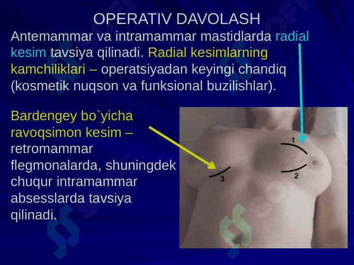 Ko`krakning Klinik anatomiyasi. Ko`krak bo`shlig`i azolari operatsiyalari. 8