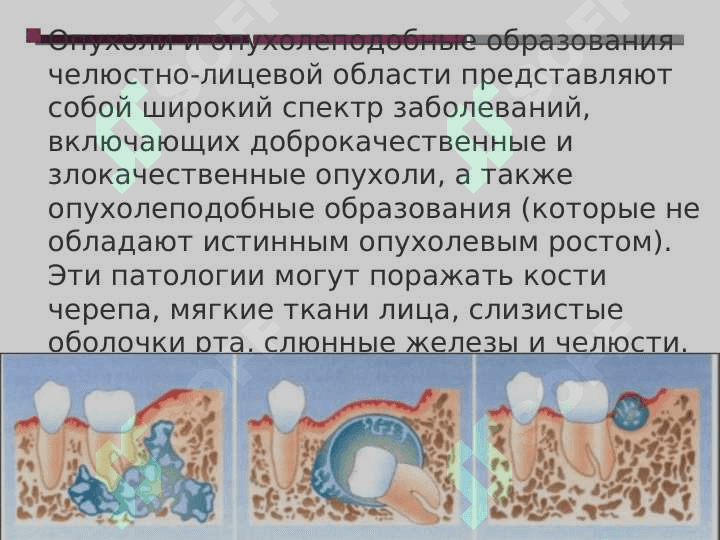 Опухоли и опухолеподобные образования челюстно-лицевой области. Доброкачественные и злокачественные опухоли. Течение, клиника, диагностика и лечение. 3