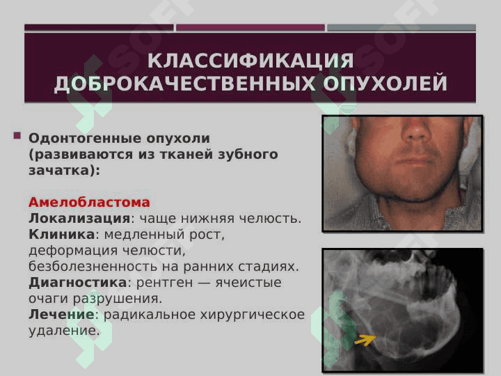 Опухоли и опухолеподобные образования челюстно-лицевой области. Доброкачественные и злокачественные опухоли. Течение, клиника, диагностика и лечение. 5