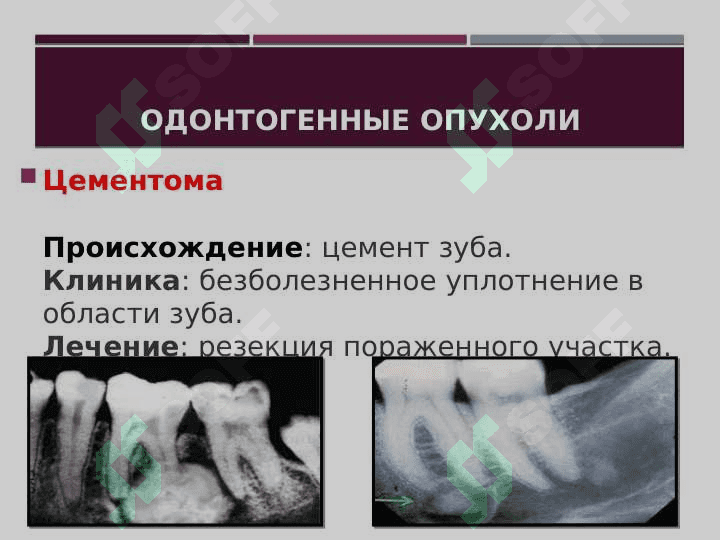 Опухоли и опухолеподобные образования челюстно-лицевой области. Доброкачественные и злокачественные опухоли. Течение, клиника, диагностика и лечение. 6