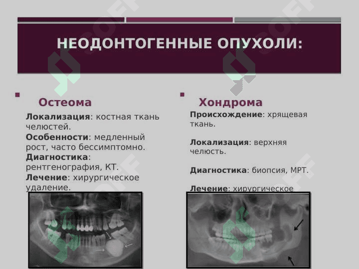 Опухоли и опухолеподобные образования челюстно-лицевой области. Доброкачественные и злокачественные опухоли. Течение, клиника, диагностика и лечение. 8