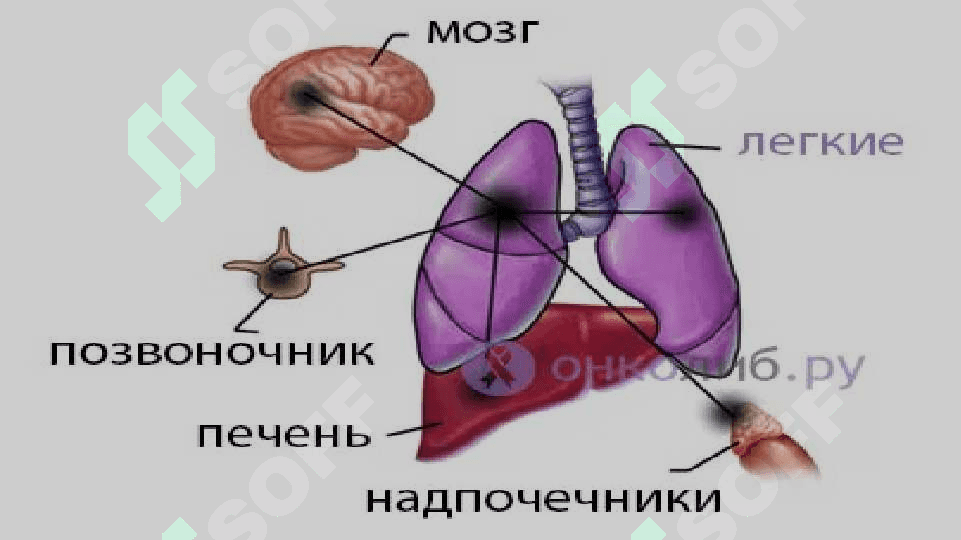 O’sma.Xavfli va xavfsiz o’smalar.Ko’p uchraydigan o’sma turlari 8