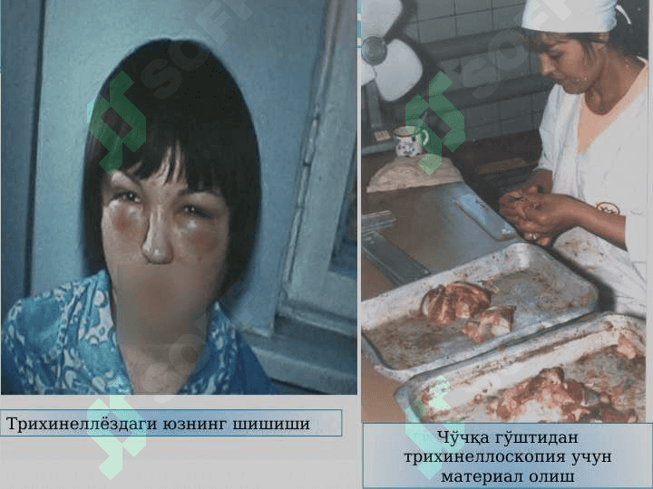Yumaloq chuvalchanglar tipi . Trixinella . Rishta . Vuxareriya . Юмалоқ чувалчанглар типи . Трихинелла . Ришта . Вухарерия . Тиббиётдаги ахамияти . Овогельминтоскопия усуллари 7