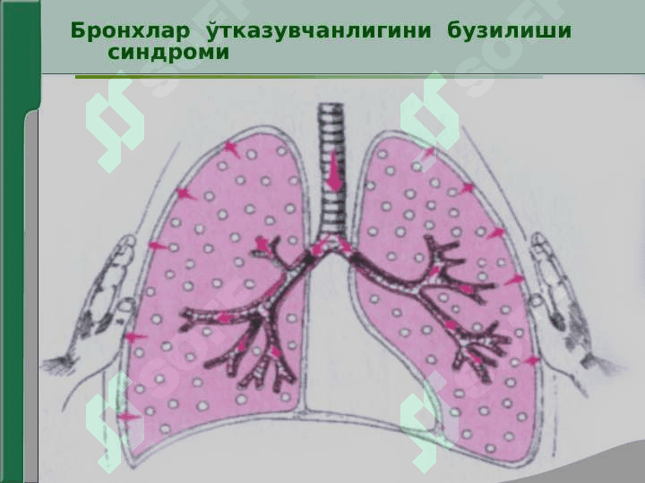 Нафас органлари касалликларида асосий клиник синдромлар . Бронхлар ўтказувчанлигини бузилиши , ўпка тўқимасида ҳавони ортиб кетиши синдроми 4