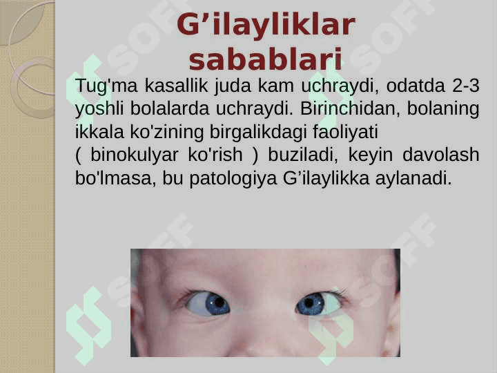 G’ilaylik(Strabizm). Diagnostika usullari 4