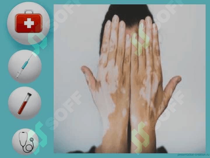 VITILIGO KASALLIGI 7