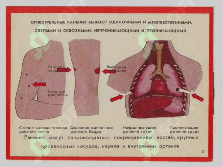 Ko`krak va qorin jaroxatlari . Кўкрак ва қорин жароҳатлари 6