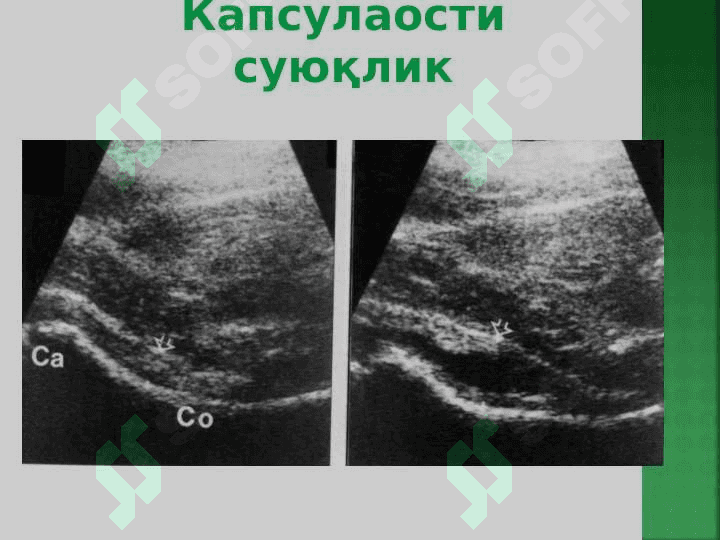 Suyak va bo`g`im tizimi kasalliklarining kompleks nur diagnostikasi . Суяк - бўғим тизими касалликларининг комплекс нур диагностикаси 6