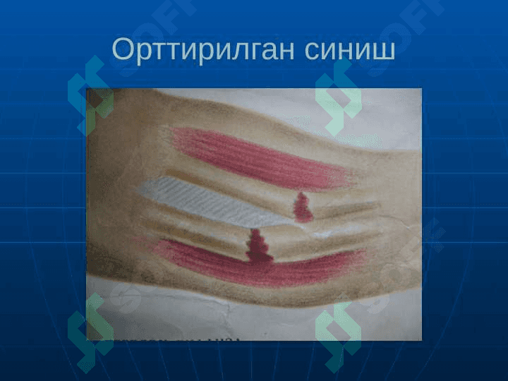 Suyaklarning sinishi va chiqishi . Суякларнинг синиши ва чикиши 5