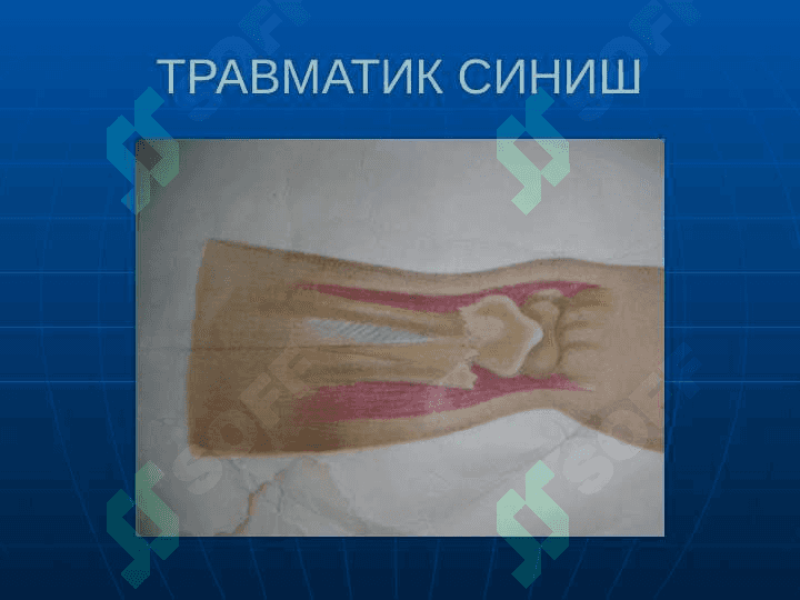 Suyaklarning sinishi va chiqishi . Суякларнинг синиши ва чикиши 7