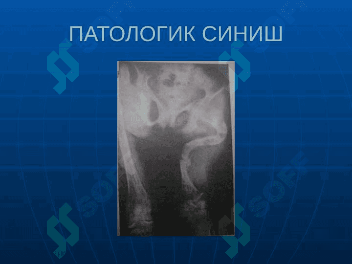 Suyaklarning sinishi va chiqishi . Суякларнинг синиши ва чикиши 8