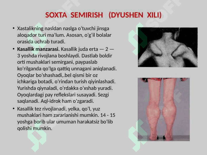 Nerv sistemasining irsiy degenerativ va zo’rayib boradigan surunkali kasalliklari. Chaqaloqlar nerv sistemasi kasalliklari 4