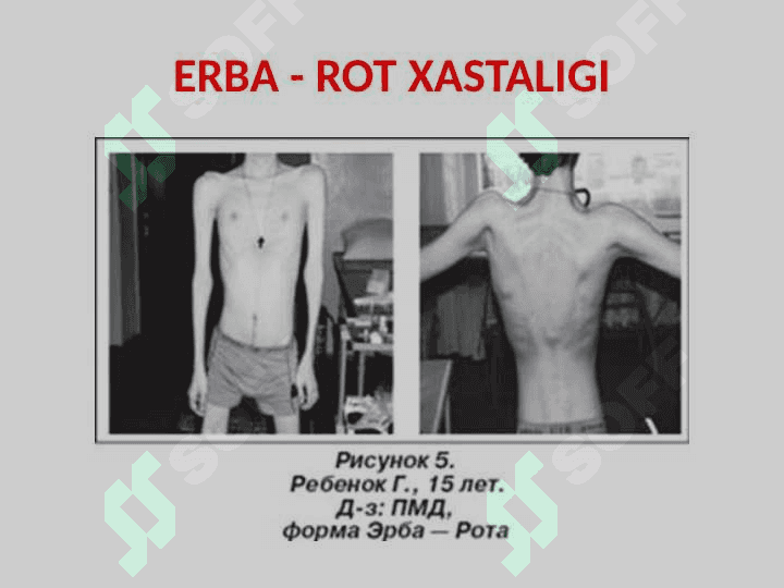 Nerv sistemasining irsiy degenerativ va zo’rayib boradigan surunkali kasalliklari. Chaqaloqlar nerv sistemasi kasalliklari 7