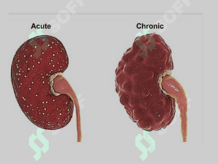 BUYRAK   YALLIG’LANISHI VA IMMUN YALLIG’LANISH  KASALLIKLARINING ETIOLOGIYASI , PATOGENEZI, KASALLIKNING KLINIK NOMOYON BO’LISHI , DIAGNOSTIKASI VA AKTIVLIK MEZONLARI 2