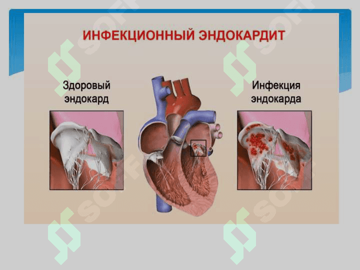 Infeksion endokardit 7