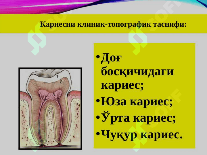 Sut tishlar kariesi, uning o'ziga xos klinik kechishi, qiyosiy tashxisi 4