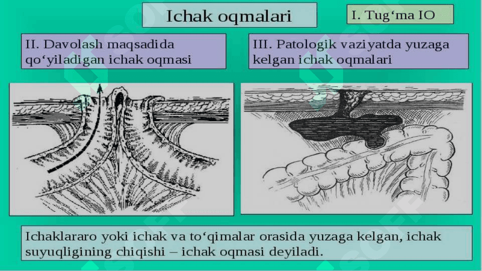 ichak oqma yaralari 5