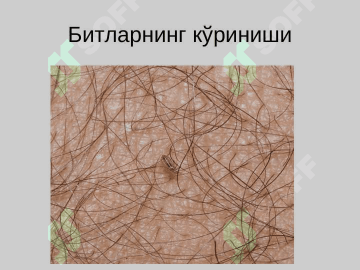 Битлаш (педикулёз) 6