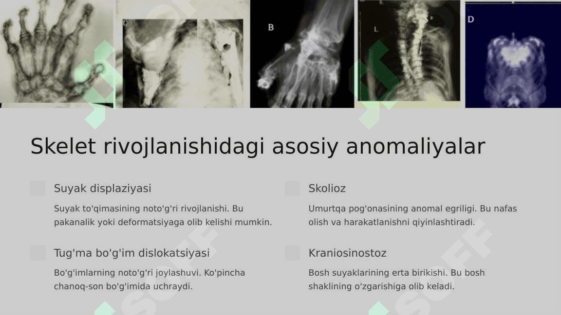 Skeletning rivojlanish anomaliyalari 4