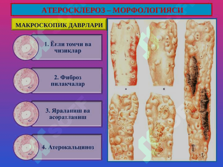 Атеросклероз. Гипертония касаллиги 6