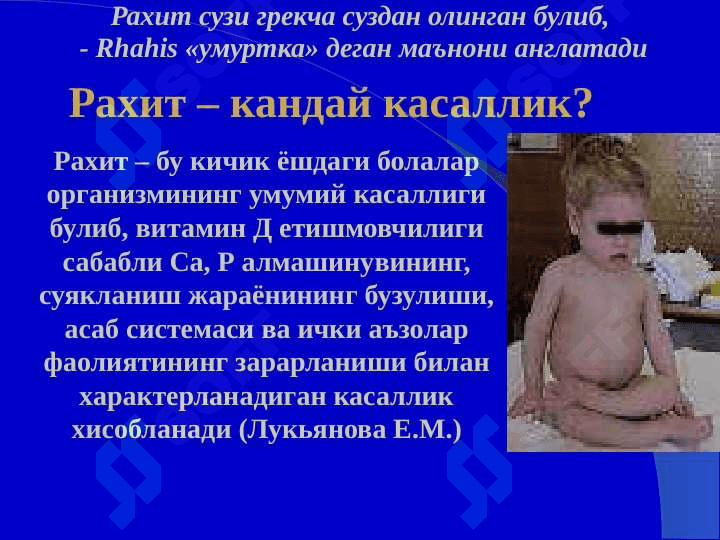 Bolalarda raxit ppt 6