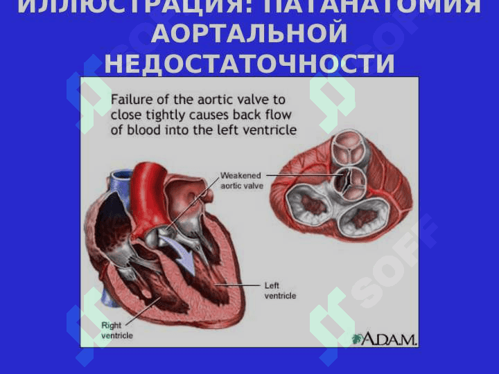 АОРТАЛЬНЫЕ  ПОРОКИ СЕРДЦА 7