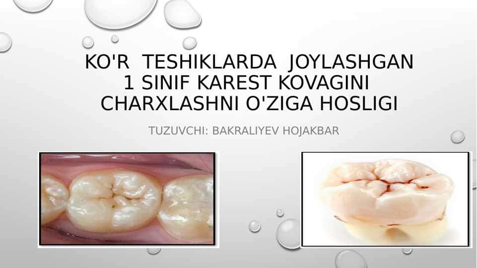 ko’r teshiklarda  joylashgan 1-sinif karest kovagini  charxlashni o'ziga hosligi 1