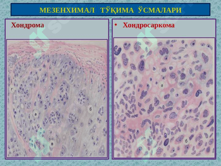 Nerv toqimasi o'smalari 5