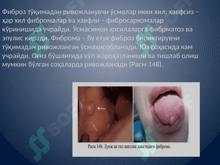 Bolalarda yuz-jag soxasi o'smalari o'ziga xos xususiyatlari. Onkologik extiyotkorlik. Bolalarda og'iz bo'shlig'i xavfsiz o'smalari va o'smasimon xosilalari. Bo'yin o'rta, yon va quloq oldi soxalarining tug'ma kistalari va oqma yo'llari; rivojlanishi, klinik ko'rinishi, tashxislash, qiyosiy tashxislash va davolash tadbirlari. 4