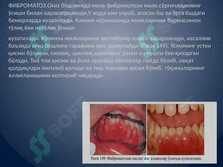 Bolalarda yuz-jag soxasi o'smalari o'ziga xos xususiyatlari. Onkologik extiyotkorlik. Bolalarda og'iz bo'shlig'i xavfsiz o'smalari va o'smasimon xosilalari. Bo'yin o'rta, yon va quloq oldi soxalarining tug'ma kistalari va oqma yo'llari; rivojlanishi, klinik ko'rinishi, tashxislash, qiyosiy tashxislash va davolash tadbirlari. 7