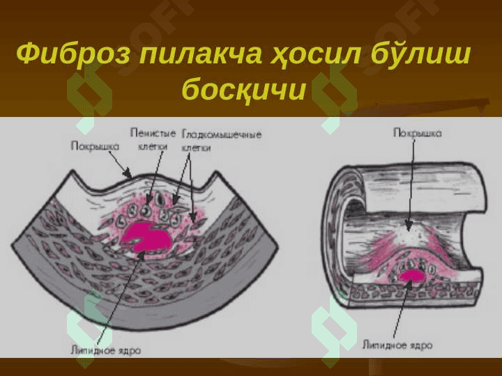 Giperlipoproteinemiyada qo‘llanadigan vositalar. Podagraga qarshi vositalar. Ateroskleroz 8