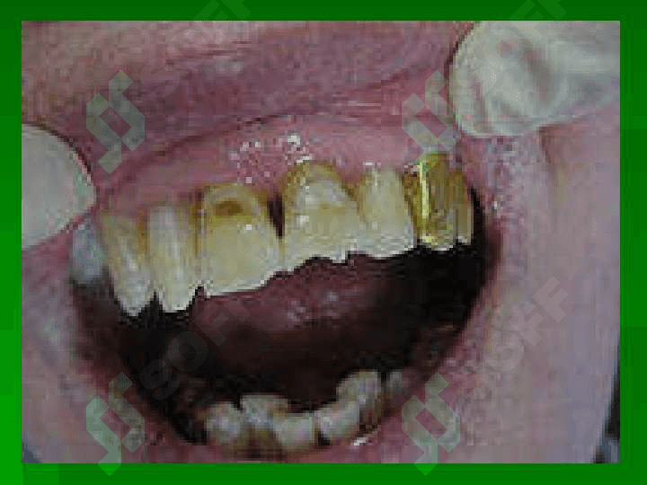 Kariyes , pulpit, periodontit 3
