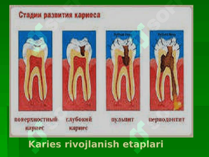 Kariyes , pulpit, periodontit 5